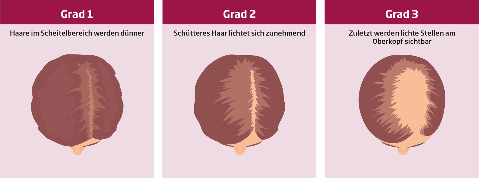 Haarausfall Bei Frauen Behandeln Infos Tipps Minoxicutan 